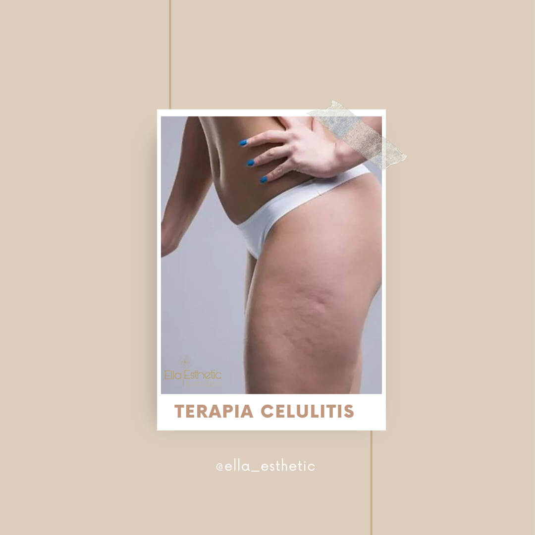 TERAPIA PARA LAS CELULITIS